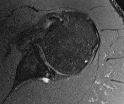 Shoulder Posterior Labral Tear with Cysts0001